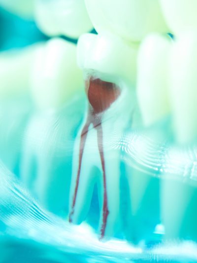 Root Canal Dental Clinic Near Me Burnaby, BC