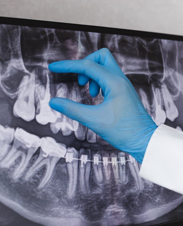 Root Canal Therapy in Burnaby